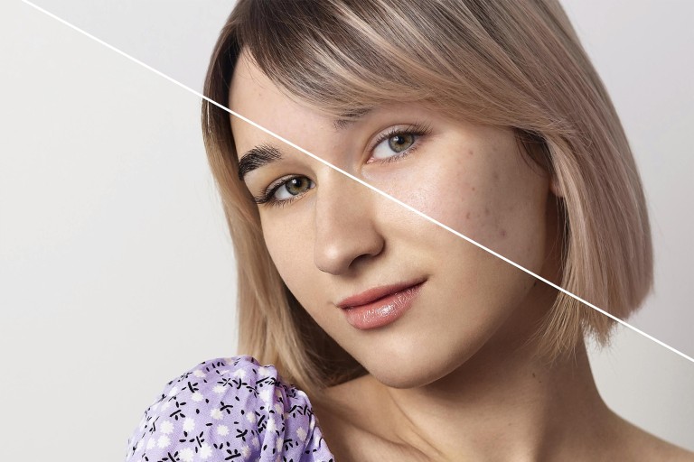 Πανάδες & Δυσχρωμίες στο πρόσωπο: Πώς να τις αντιμετωπίσετε αποτελεσματικά!