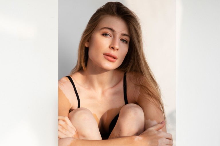 Πόσα ξέρεις για τη λεύκη;